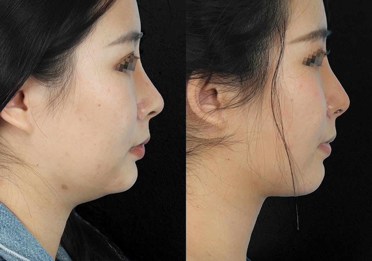 Before & Afters Before & After Gallery - Patient 285213 - Image 1