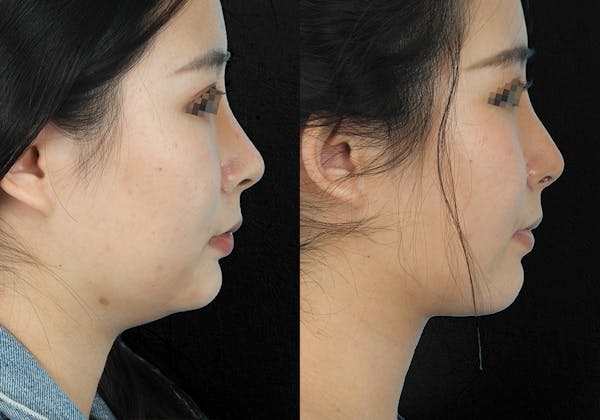 Before & Afters Before & After Gallery - Patient 285213 - Image 1