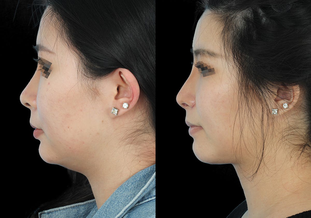 Before & Afters Before & After Gallery - Patient 285213 - Image 2