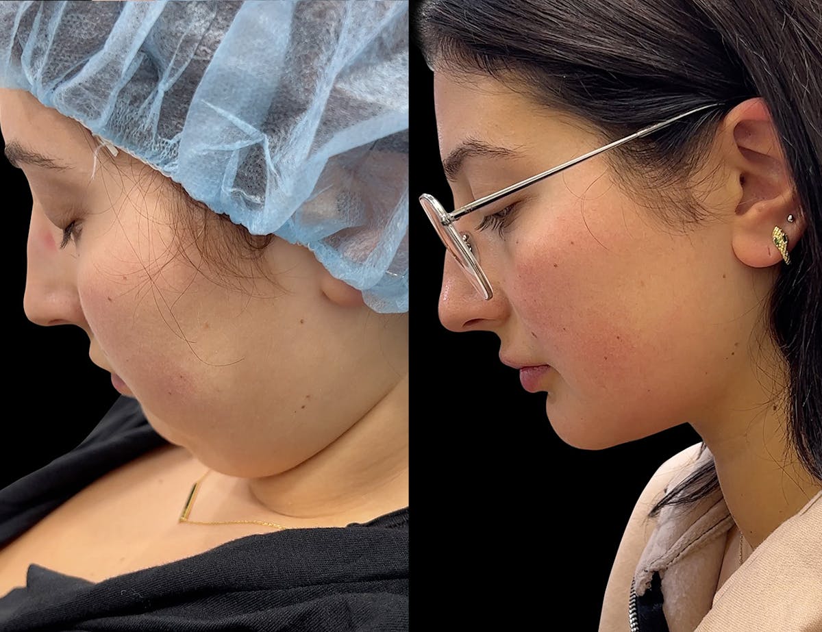 Before & Afters Before & After Gallery - Patient 828515 - Image 2