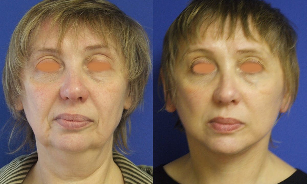 Before & Afters Before & After Gallery - Patient 283623 - Image 2