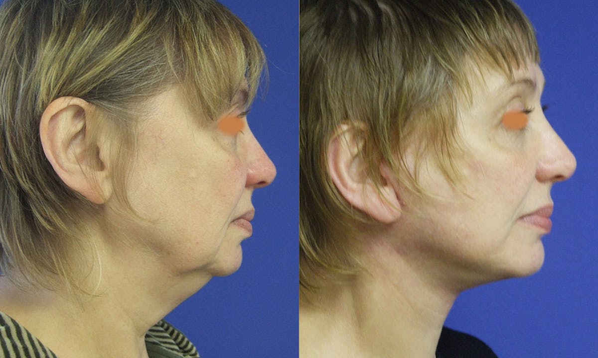 Before & Afters Before & After Gallery - Patient 283623 - Image 1