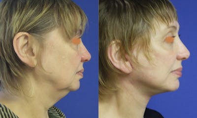 Before & Afters Before & After Gallery - Patient 283623 - Image 1