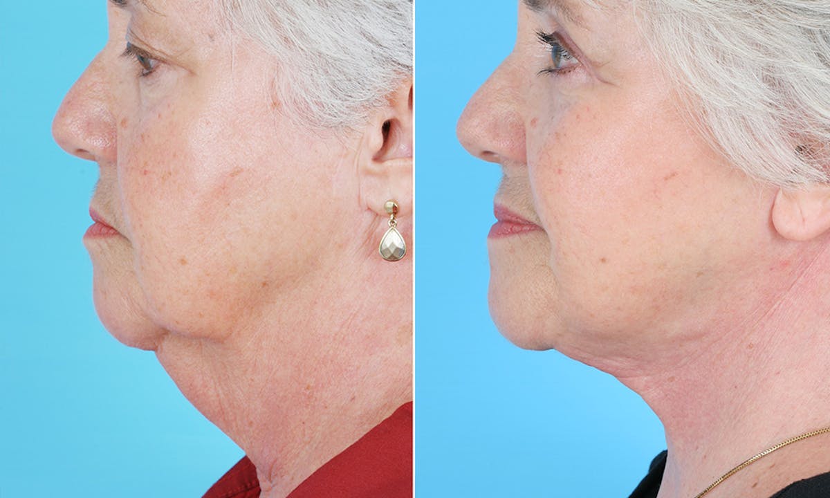 Before & Afters Before & After Gallery - Patient 322323 - Image 1