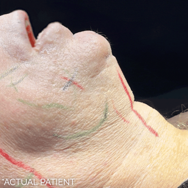 Intraop Before & After Gallery - Patient 298637 - Image 1