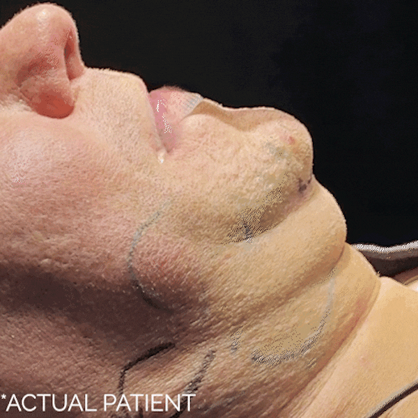 Intraop Before & After Gallery - Patient 417001 - Image 1