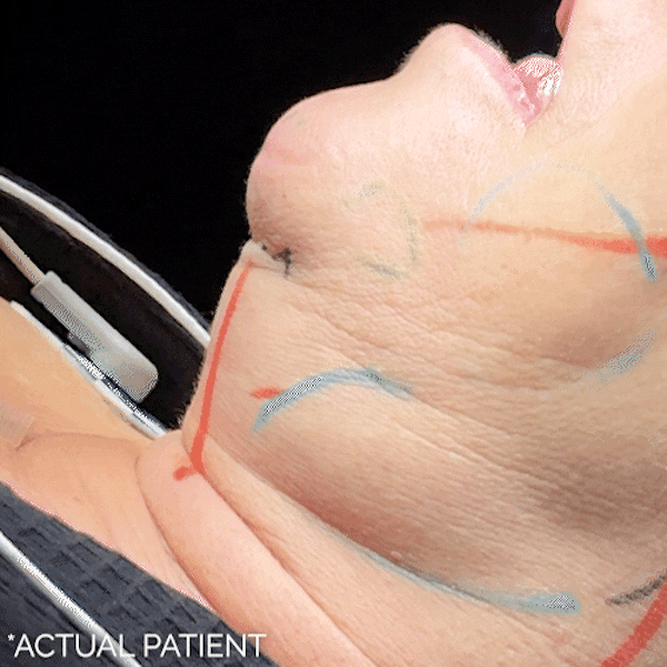 Intraop Before & After Gallery - Patient 405263 - Image 1