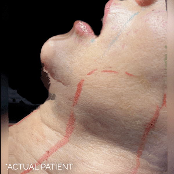 Intraop Before & After Gallery - Patient 554692 - Image 1