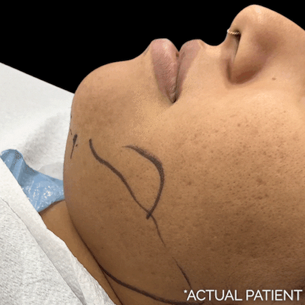 Intraop Before & After Gallery - Patient 338365 - Image 1
