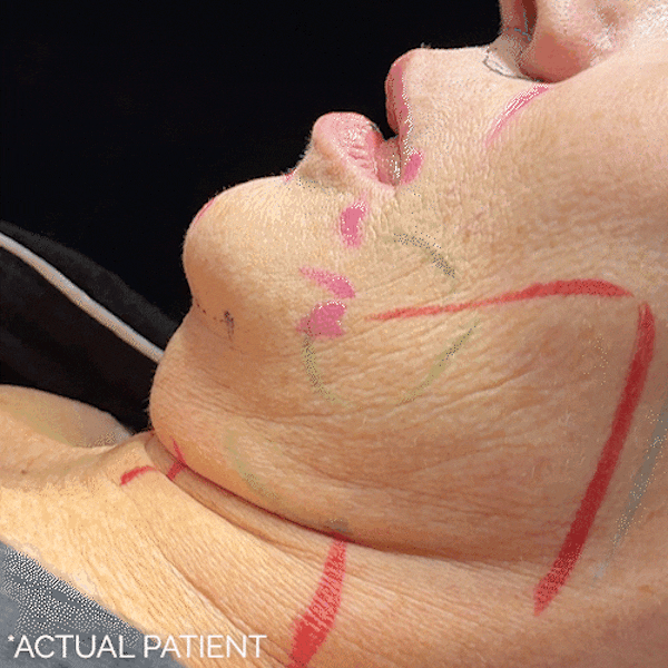 Intraop Before & After Gallery - Patient 831267 - Image 1
