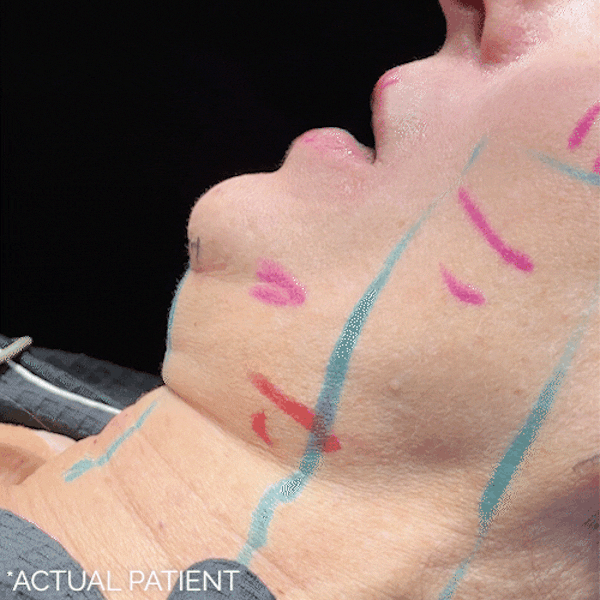 Intraop Before & After Gallery - Patient 262231 - Image 1