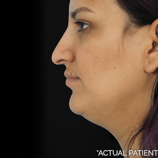 Gifs Before & After Gallery - Patient 116159 - Image 1
