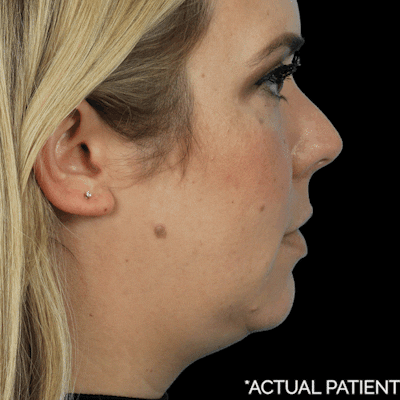 Gifs Before & After Gallery - Patient 648259 - Image 1