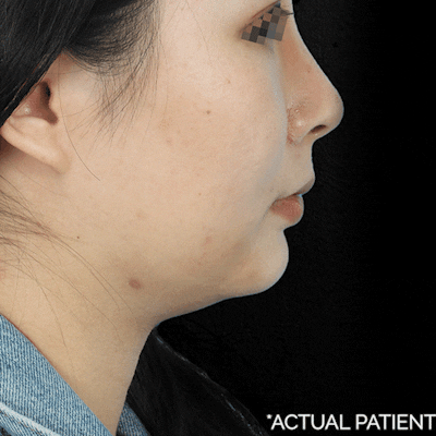 Gifs Before & After Gallery - Patient 326188 - Image 1