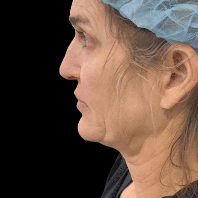 Gifs Before & After Gallery - Patient 277859 - Image 1