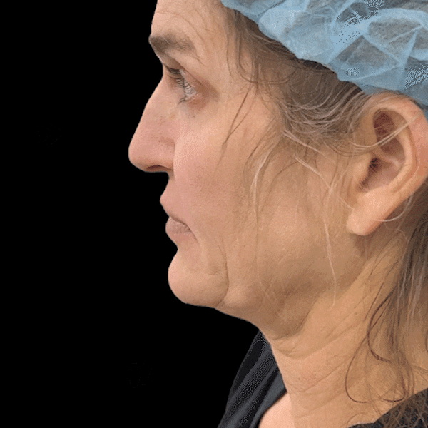 Gifs Before & After Gallery - Patient 277859 - Image 1