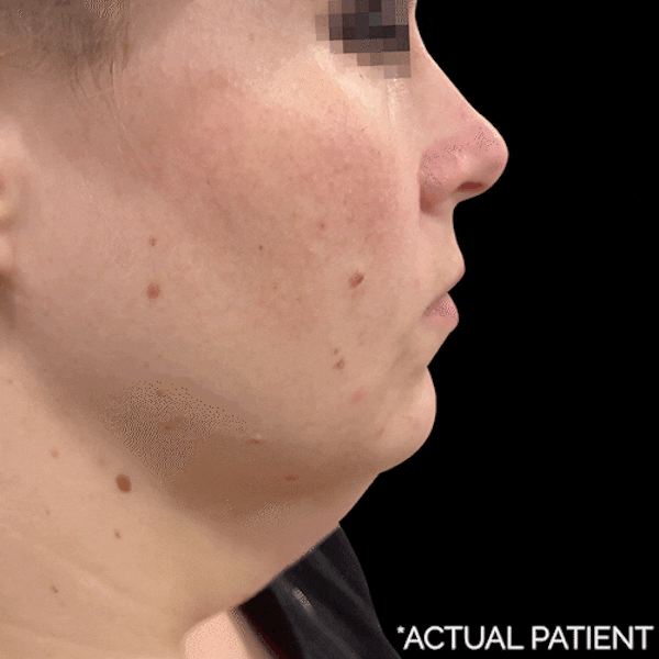 Gifs Before & After Gallery - Patient 422106 - Image 1