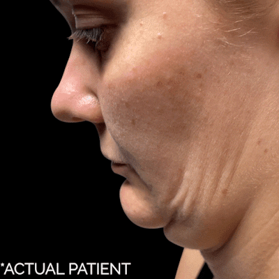 Gifs Before & After Gallery - Patient 124540 - Image 1