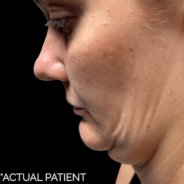Gifs Before & After Gallery - Patient 124540 - Image 1