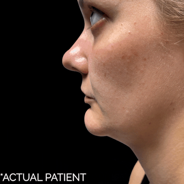 Gifs Before & After Gallery - Patient 235111 - Image 1