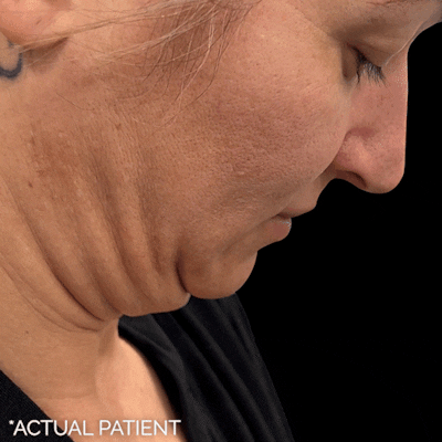 Gifs Before & After Gallery - Patient 263214 - Image 1