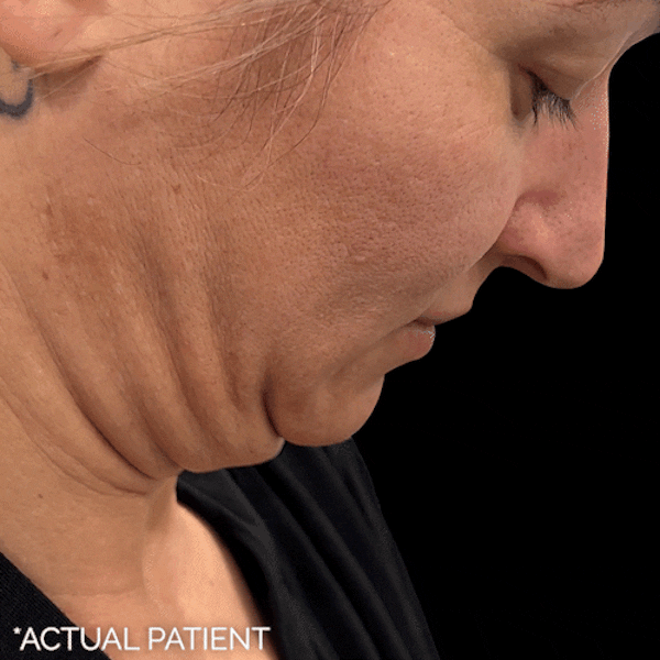 Gifs Before & After Gallery - Patient 263214 - Image 1