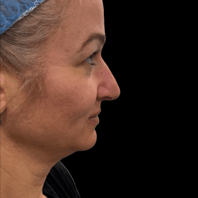 Gifs Before & After Gallery - Patient 329013 - Image 1
