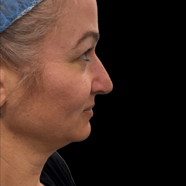 Gifs Before & After Gallery - Patient 329013 - Image 1