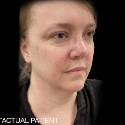 Gifs Before & After Gallery - Patient 407524 - Image 1