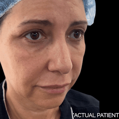 Gifs Before & After Gallery - Patient 414532 - Image 1