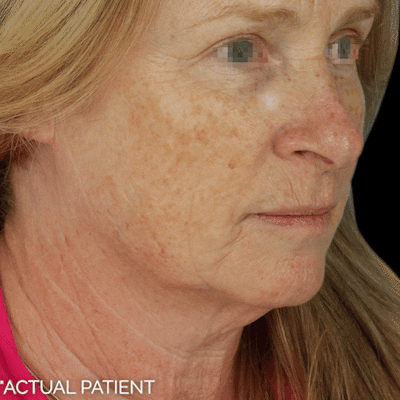 Gifs Before & After Gallery - Patient 336139 - Image 1