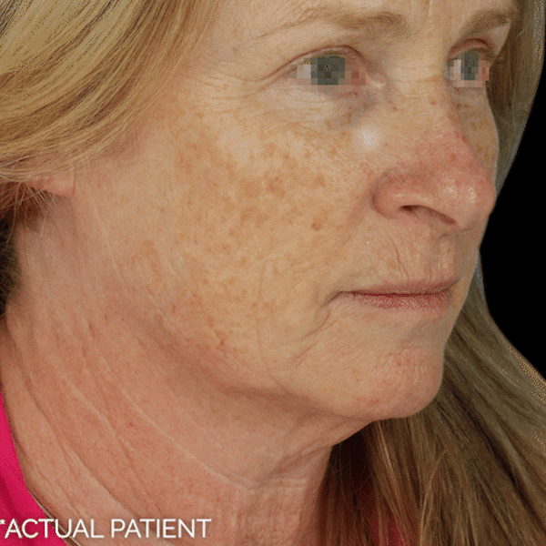 Gifs Before & After Gallery - Patient 336139 - Image 1