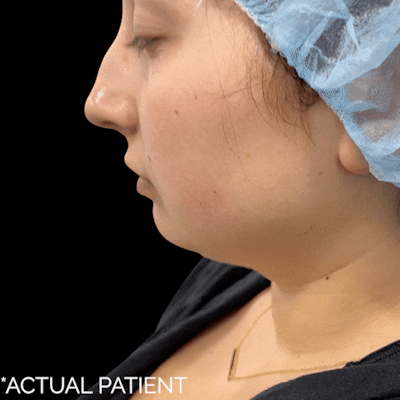 Gifs Before & After Gallery - Patient 336552 - Image 1