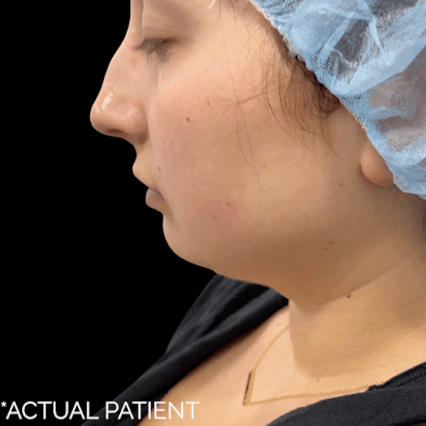 Gifs Before & After Gallery - Patient 336552 - Image 1