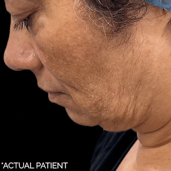 Gifs Before & After Gallery - Patient 295262 - Image 1
