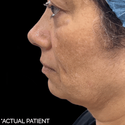 Gifs Before & After Gallery - Patient 205257 - Image 1
