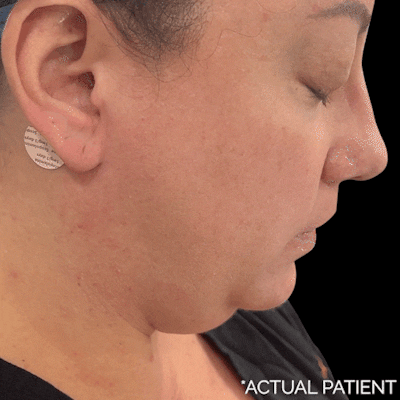 Gifs Before & After Gallery - Patient 210797 - Image 1