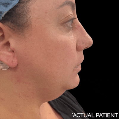 Gifs Before & After Gallery - Patient 348685 - Image 1