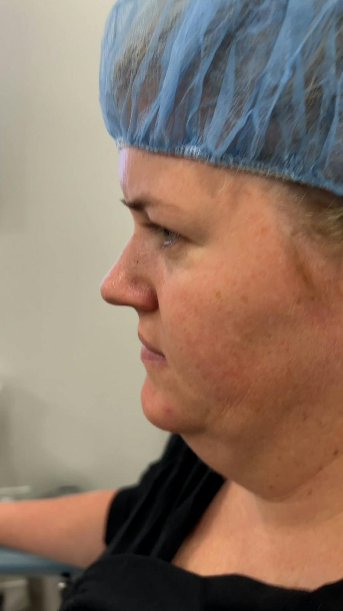 1 Week After Before & After Gallery - Patient 169594 - Image 6