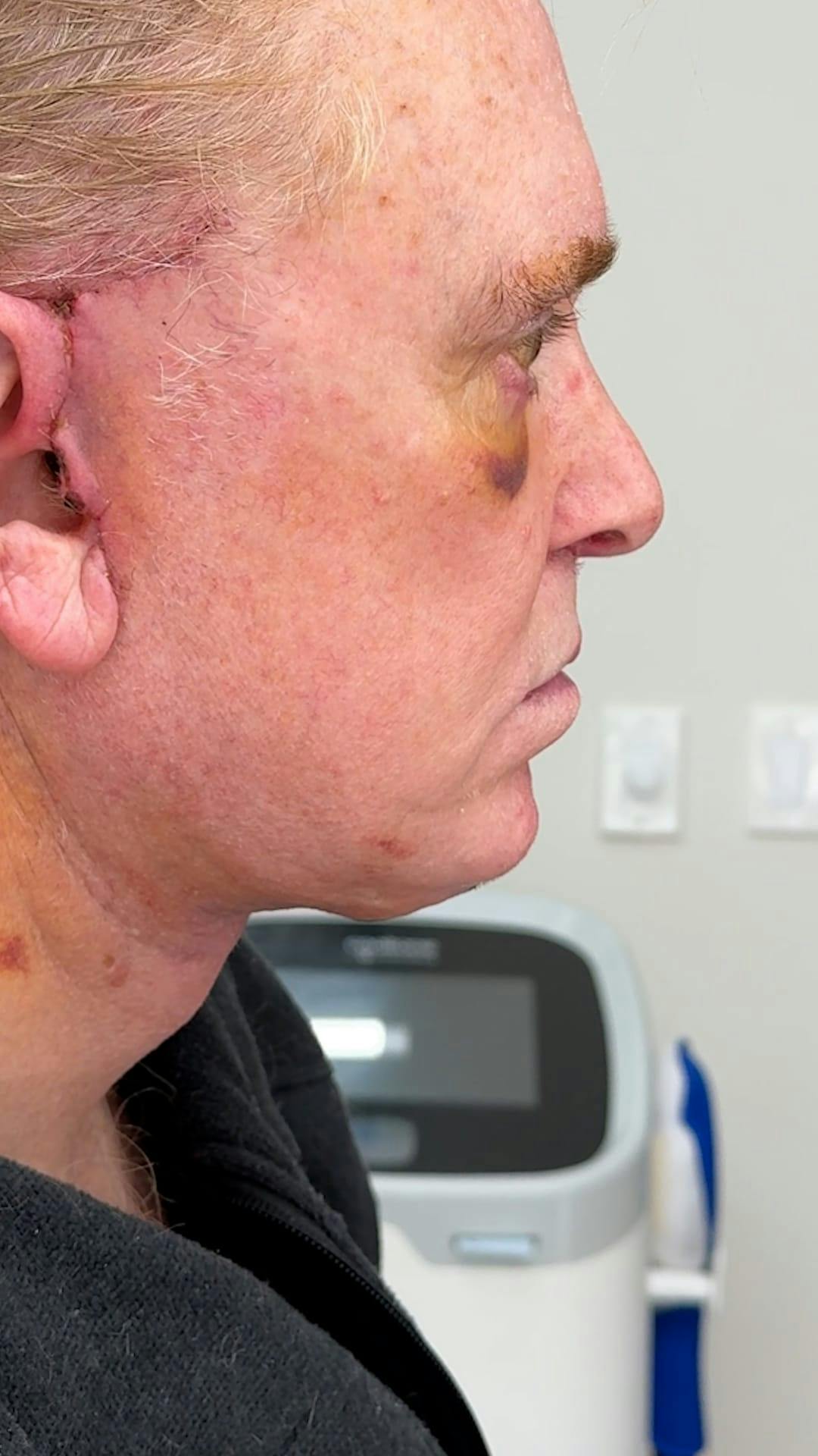 1 Week After Before & After Gallery - Patient 354748 - Image 2