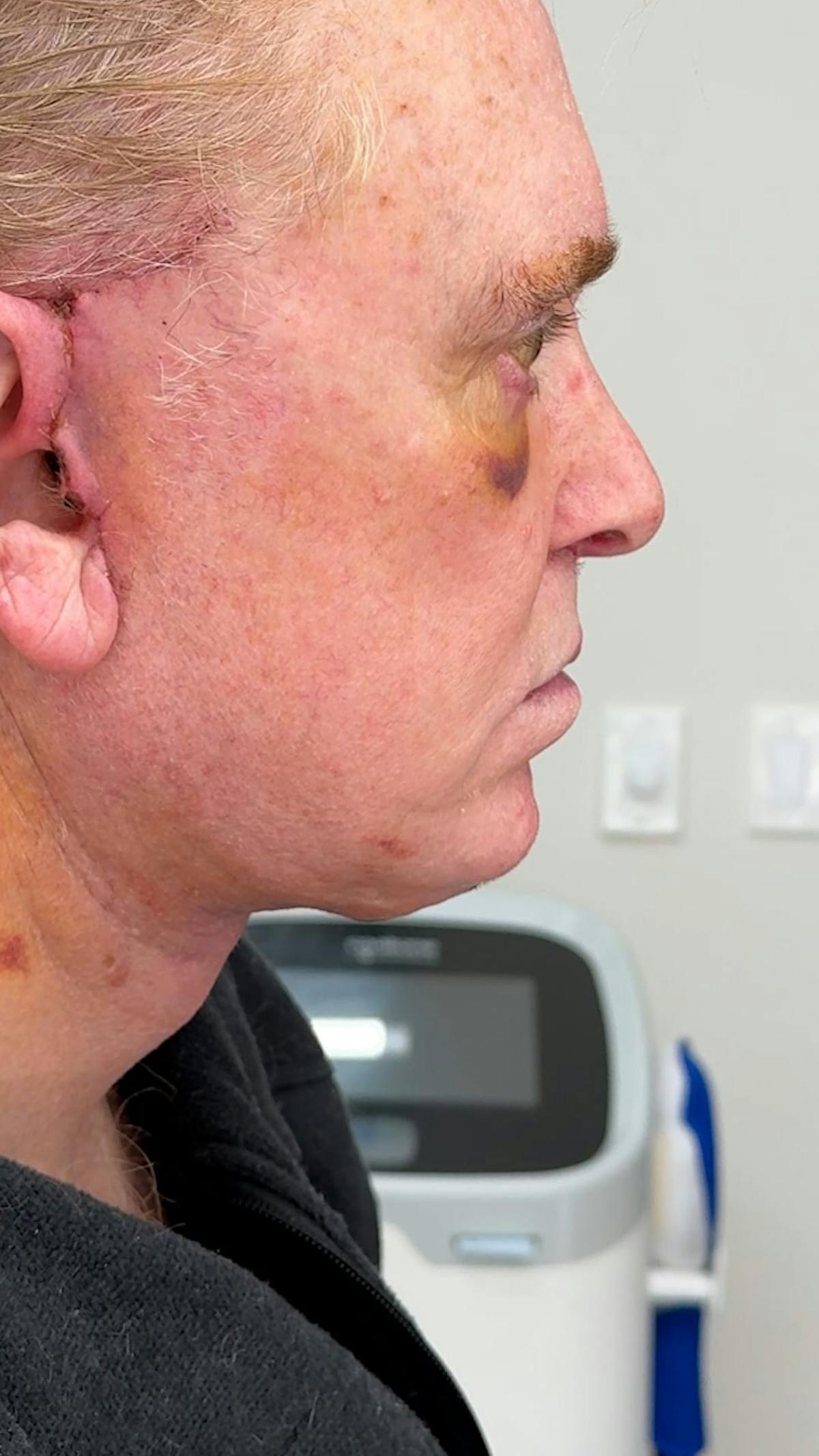 1 Week After Before & After Gallery - Patient 354748 - Image 2