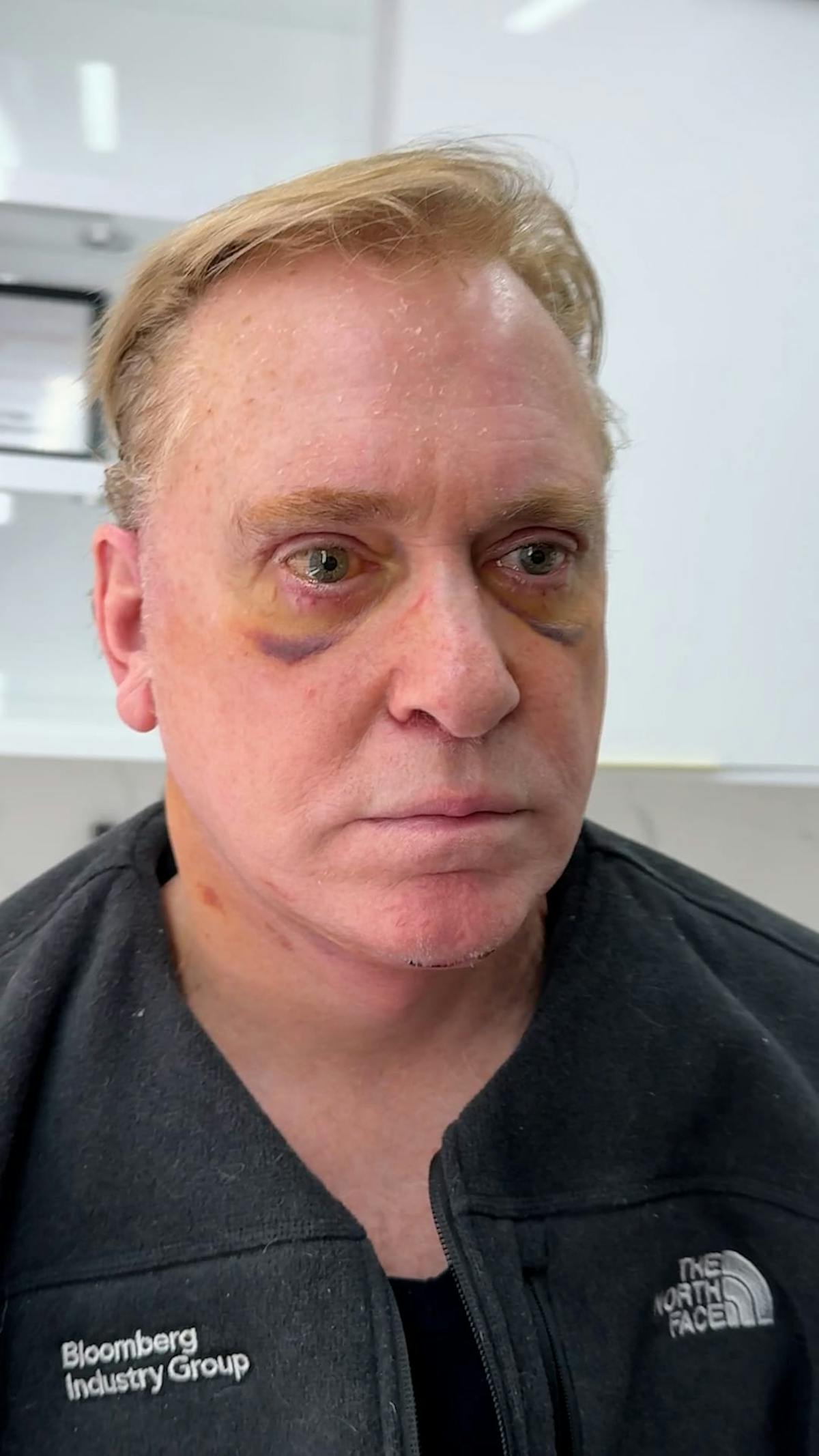 1 Week After Before & After Gallery - Patient 354748 - Image 4