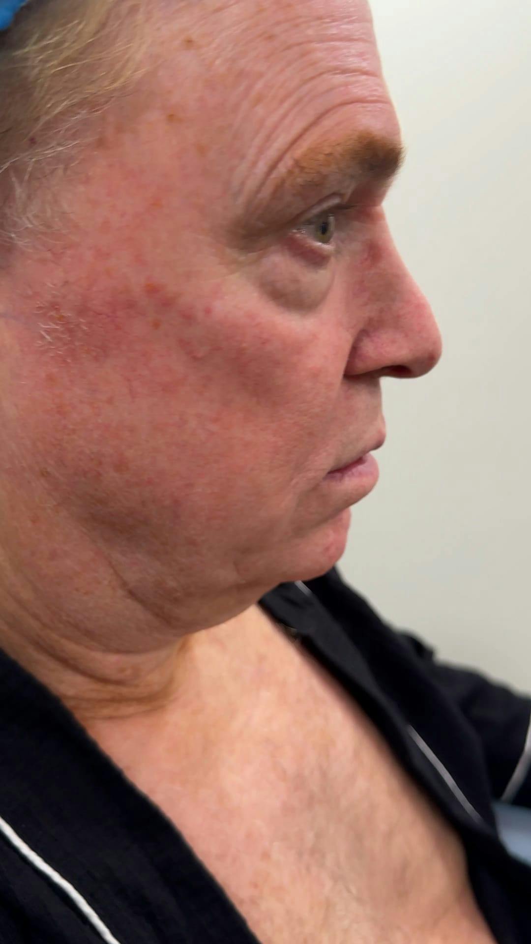 1 Week After Before & After Gallery - Patient 354748 - Image 1