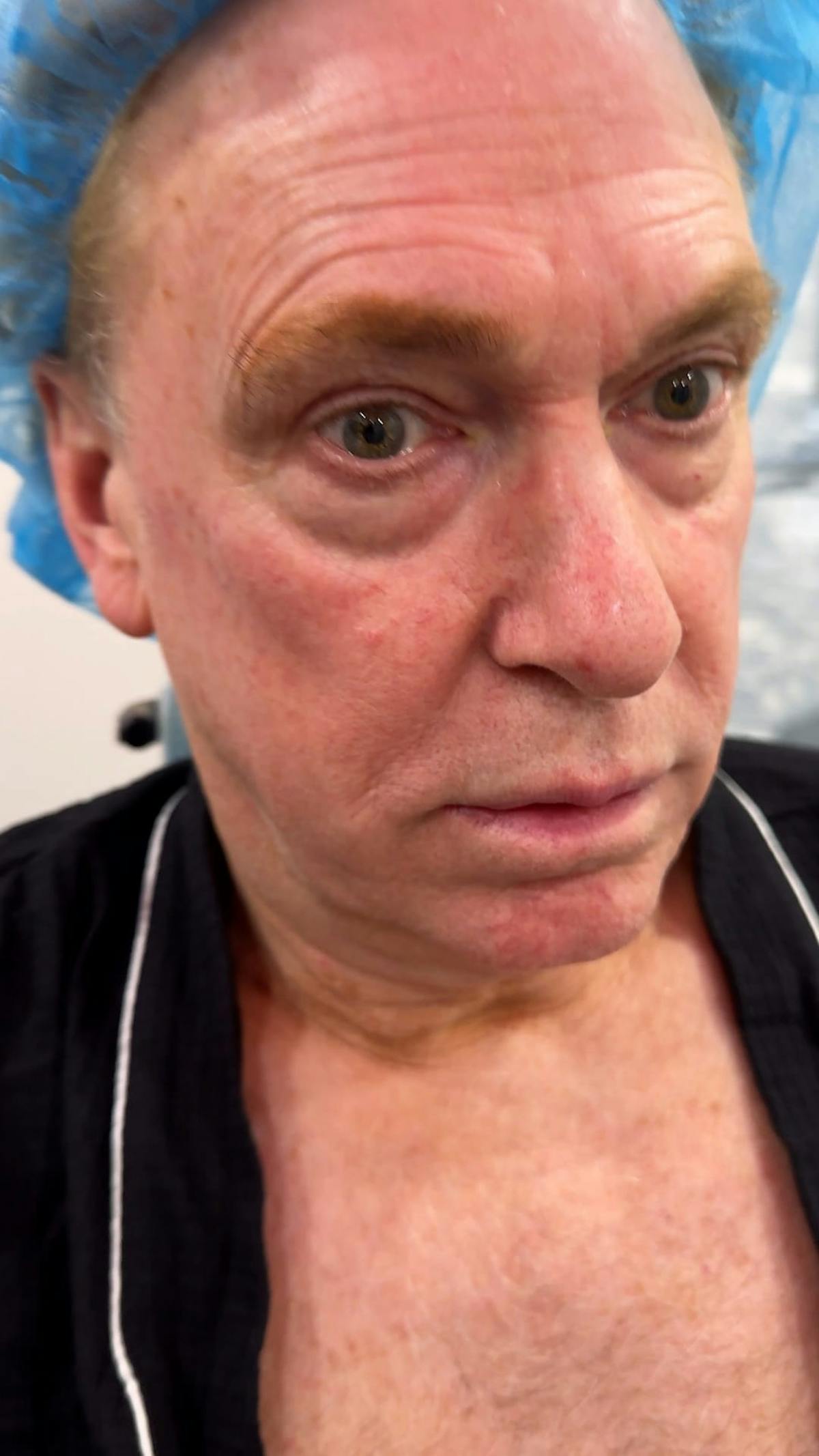 1 Week After Before & After Gallery - Patient 354748 - Image 3