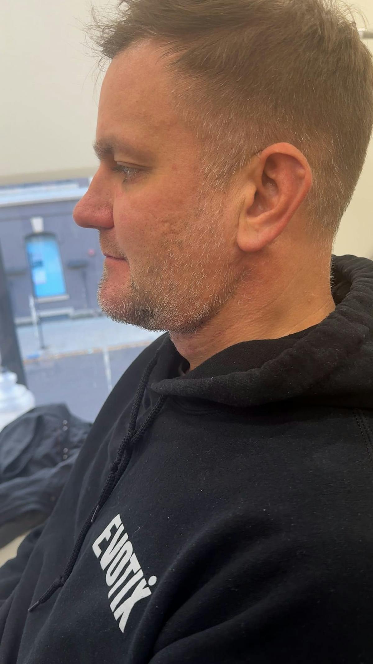 1 Week After Before & After Gallery - Patient 425757 - Image 2