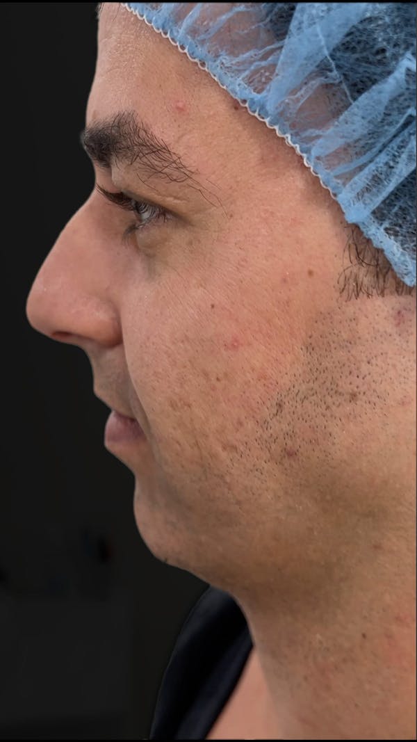 Before & Afters Before & After Gallery - Patient 290323 - Image 1
