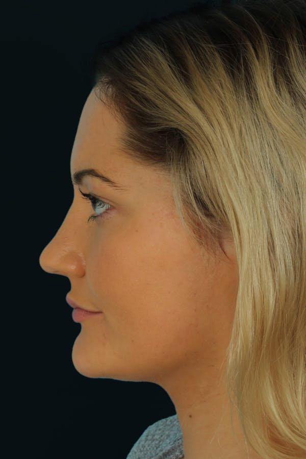 Before & Afters Before & After Gallery - Patient 217166 - Image 2