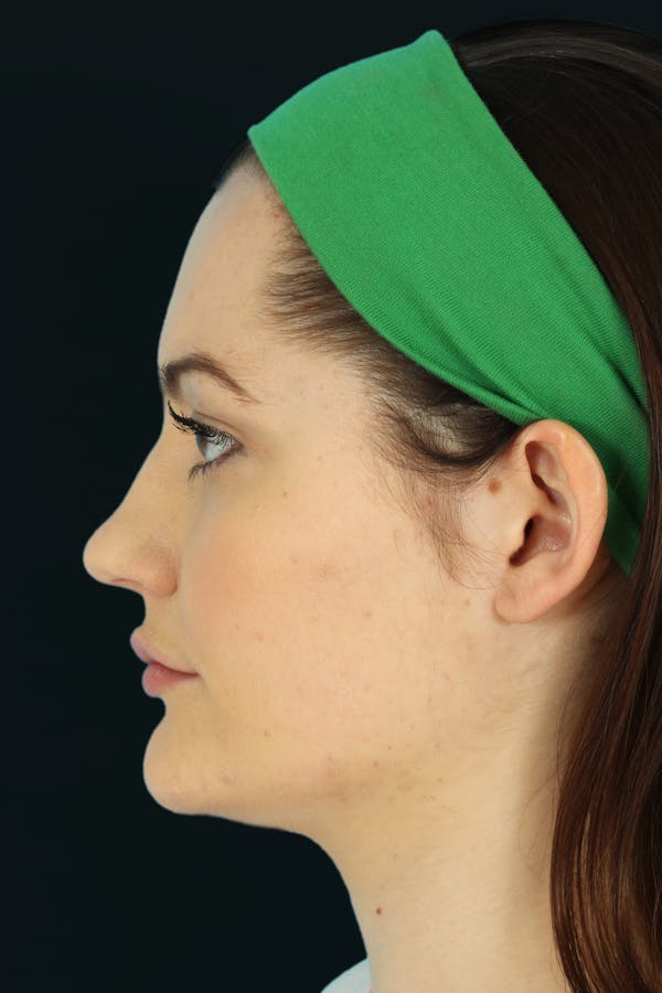 Before & Afters Before & After Gallery - Patient 217166 - Image 1
