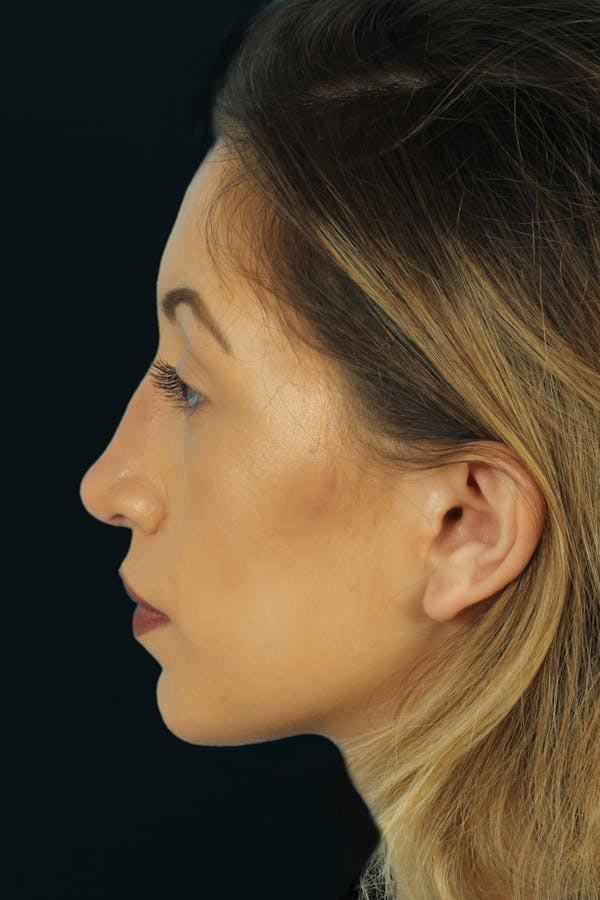 Before & Afters Before & After Gallery - Patient 153005 - Image 2