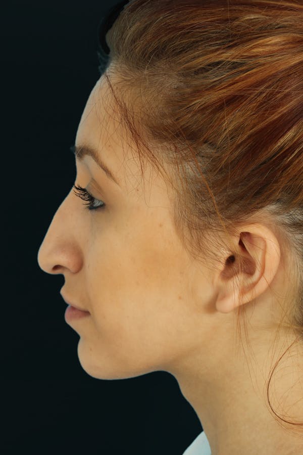 Before & Afters Before & After Gallery - Patient 153005 - Image 1